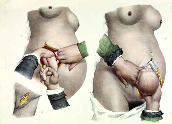 Birth by Caesarean