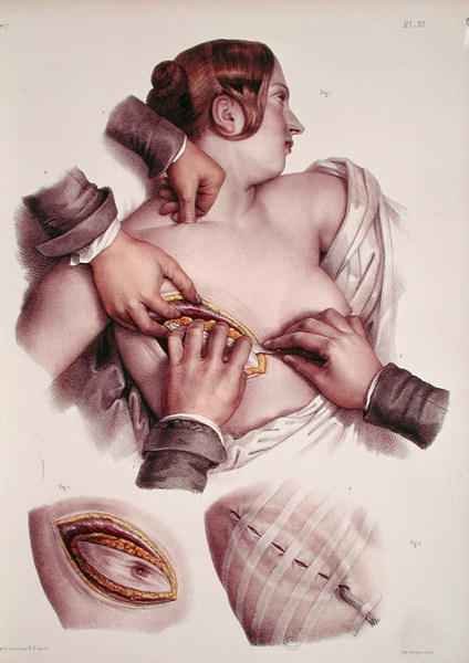 Operating on a cancerous tumour