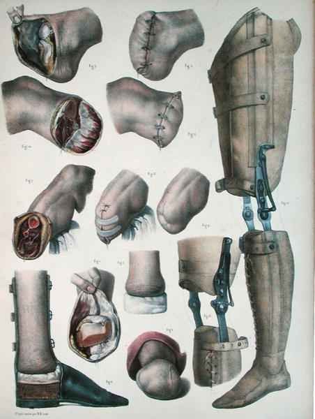 Amputations and Prosthetics