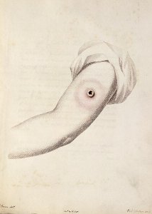 Cowpox pustule on an arm, from An Inquiry into the Causes and Effects of the Variolae Vaccinae by Edward Jenner 1749-1823 engraved by Pearce, c.1800
