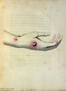 Cowpox pustule on the arm of Sarah Nelmes, from An Inquiry into the Causes and Effects of the Variolae Vaccinae by Edward Jenner 1749-1823 engraved by Pearce, c.1800